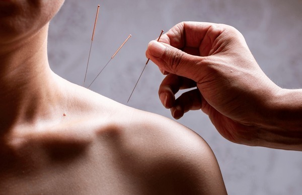 acupuncture